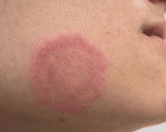 Fungal Infection in Noida & Delhi NCR — The Skin Matrix
